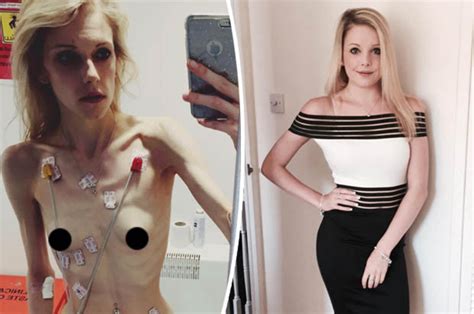 anorexia recovery teen told she was dying makes amazing recovery