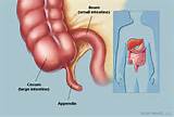 Cancer Of The Appendix Causes