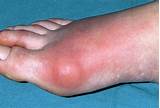 Photos of Gout Symptoms