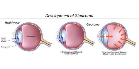 glaucoma treatment  ulwe navi mumbai ulwe eye clinc