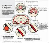 Migraine Headache With Vomiting Photos