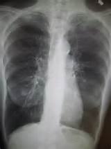 Nursing Diagnosis Emphysema Pictures