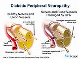 Peripheral Neuropathy Diagnosis Pictures