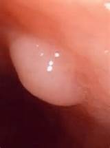 Cancer Polyps In Colon Pictures