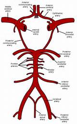 Cerebral Artery Occlusion With Infarction Pictures