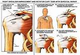 Pictures of Rotator Cuff Symptoms Of Injury