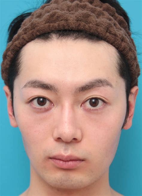 眉間~鼻筋にかけてのシリコンプロテーゼ ボツリヌストキシン注射（エラ、プチ小顔術）をした20代男性の症例写真 ： 美容整形の高須クリニック