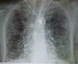 Chronic Interstitial Lung Disease
