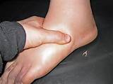 Images of What Causes Edema In Cancer Patients