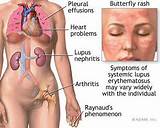Pictures of Lupus Autoimmune Disease Symptoms