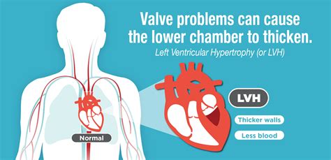 left ventricular hypertrophy lvh american heart association cpr  aid