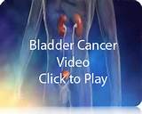 Alternative Treatment Bladder Cancer Photos
