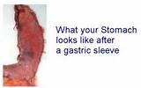 Photos of Portion Size After Gastric Sleeve