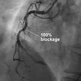 Photos of Occluded Coronary Artery
