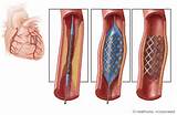 Coronary Artery Stent Images