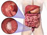 Images of Test Cancer Colon