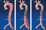 Type B Aortic Dissection Treatment Pictures