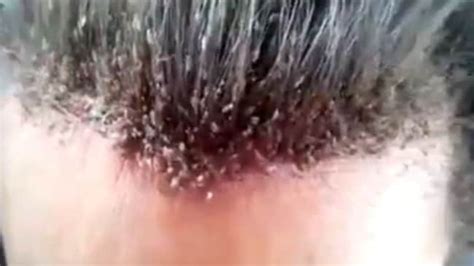 Video Emerges Online Of The Most Shocking Case Of Head Lice Ever The