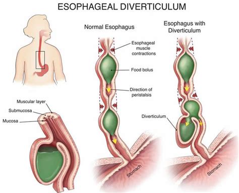 esophageal diverticulum  types symptoms diagnosis treatment