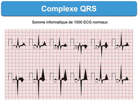 complexe qrs  cardiogram