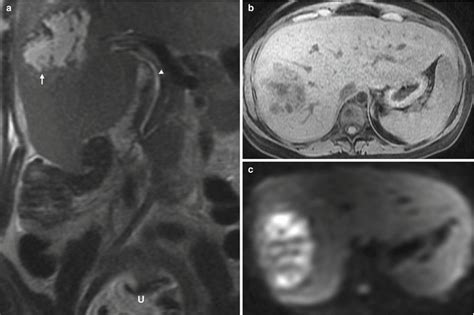 Mri Of Hepatobiliary And Pancreatic Disorders In Pregnancy Mri Of