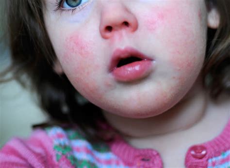baby rashes types symptoms