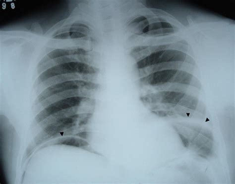 chest  ray showing  air  diaphragm single arrow head
