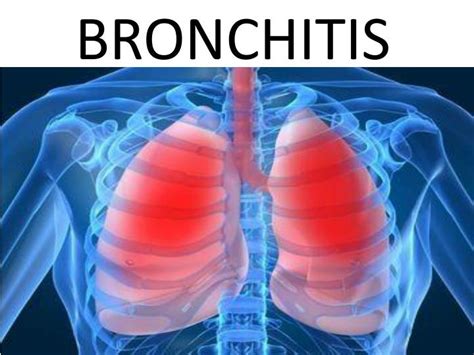 ppt bronchitis powerpoint presentation free download id 1857430