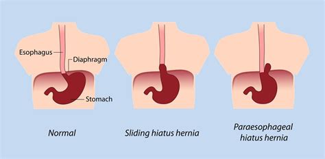hernia symptoms abdomen hiatal hernia types  hernia treatment hernia surgery  perth