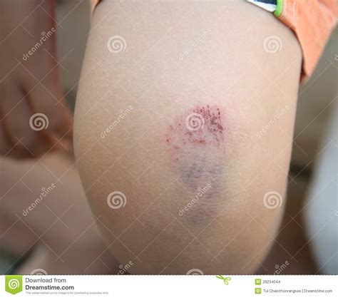 kneuzing op knie stock foto image  litteken verwonding