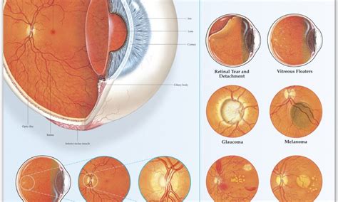Disorders Of The Eye {infographic} Best Infographics
