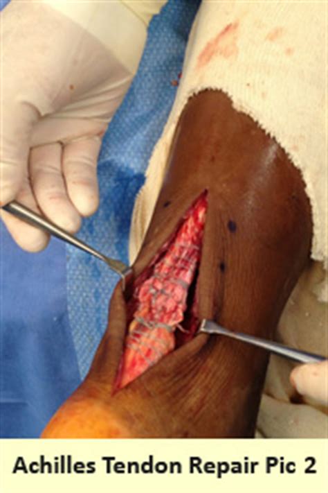 Achilles Tendon Tear and Repair - The Beltsville Foot and