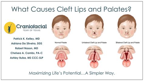 cleft lips  palates dell childrens craniofacial team