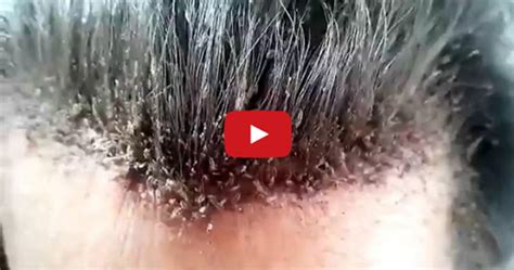Video Of Disgusting Head Lice Infestation Goes Viral
