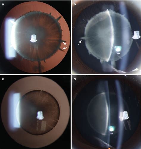 classification and morphology of pediatric cataracts obgyn key