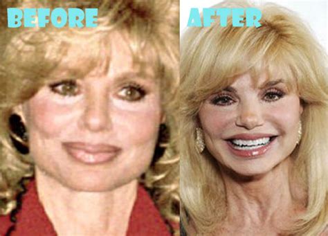 loni anderson plastic surgery before and after pictures