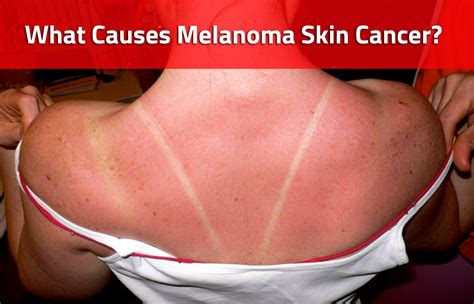 What Causes Melanoma Skin Cancer
