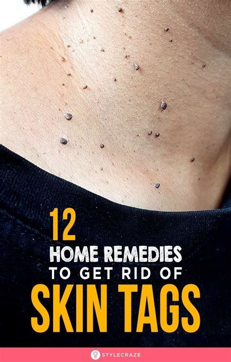 12 effective home remedies to remove skin tags they appear as small