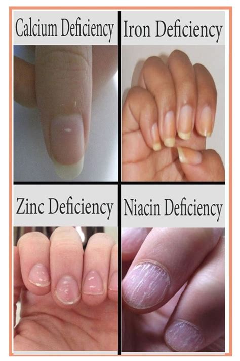 atnaturalholisticremediesforlife linktree nail health fingernail