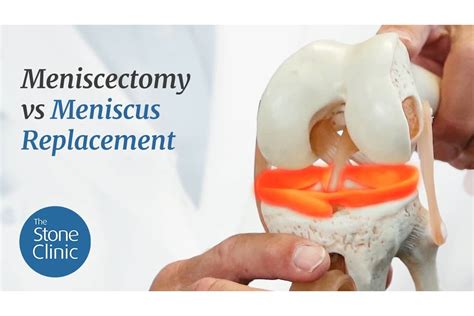meniscectomy  meniscus replacement video blog