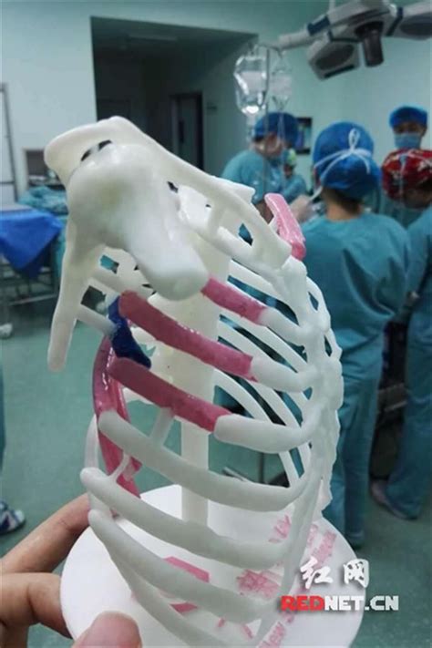 3d Printed Rib Cage Used To Assist Surgery On 25 Year Old Man With