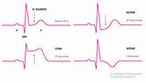 Images of Unstable Angina Nursing Diagnosis
