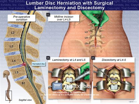 Lumbar Disc Herniation With Surgical Laminectomy And