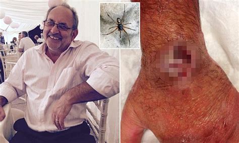 false widow spider bite leaves lorry driver with gaping hole in his