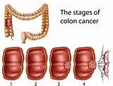 Colon Cancer Stage 4 Symptoms Pictures