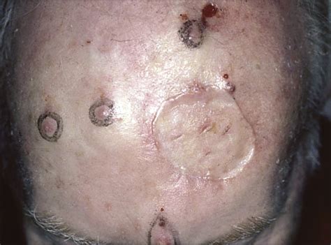 Special Concern About Squamous Cell Carcinoma Of The Scalp In Organ