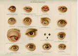 Pictures of Medical Conditions Of The Eye
