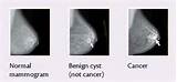 Pictures of Benign Lumpectomy