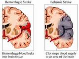 Different Types Of Strokes Photos