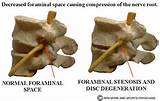 Foramen Stenosis Images